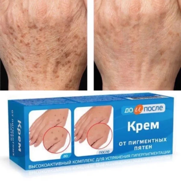 Kem Tay Kpem Trị Đồi Mồi, Vết Nám Nga